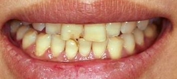 福州修复牙缺损要多少钱?